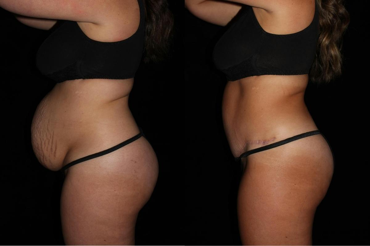 Tummy Tuck Before & After Gallery - Patient 351505 - Image 3