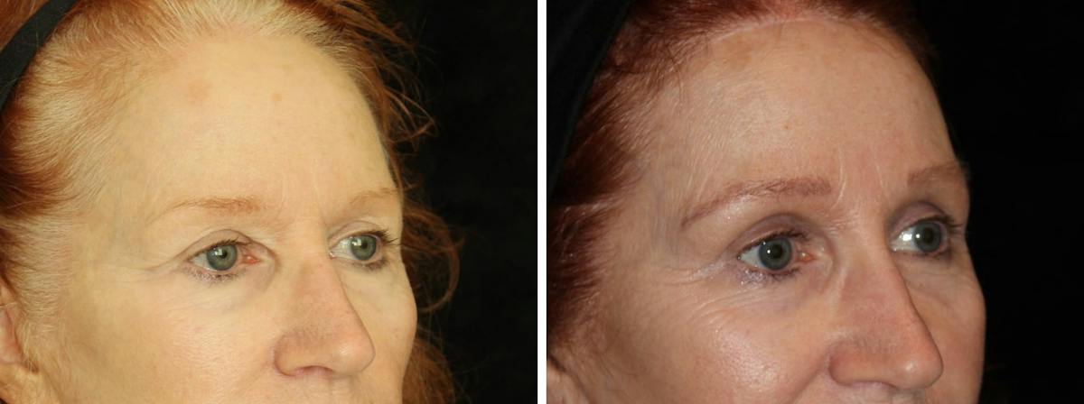 Brow Lift Before & After Gallery - Patient 330958 - Image 2