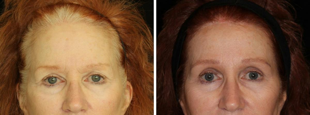 Brow Lift Before & After Gallery - Patient 330958 - Image 1