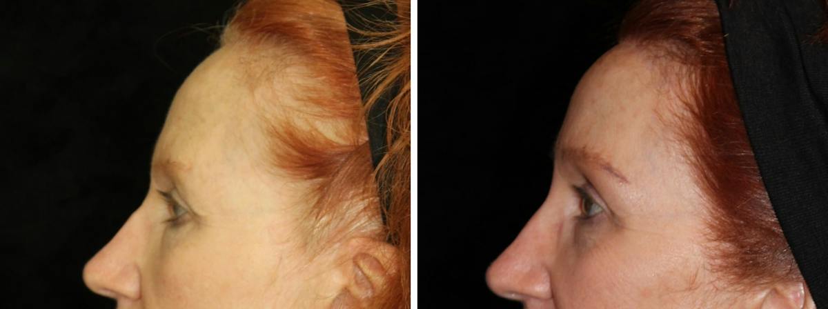 Brow Lift Before & After Gallery - Patient 330958 - Image 3
