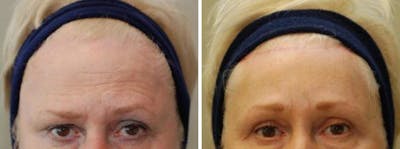 Brow Lift Before & After Gallery - Patient 244968 - Image 1
