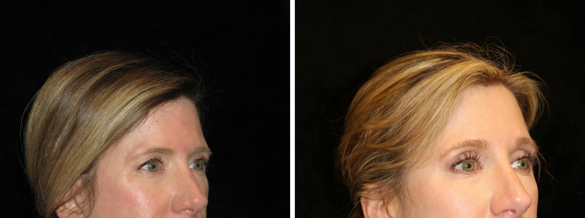 Brow Lift Before & After Gallery - Patient 331215 - Image 2