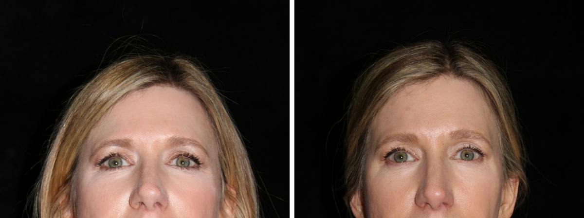 Brow Lift Before & After Gallery - Patient 331215 - Image 1
