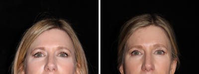 Brow Lift Before & After Gallery - Patient 331215 - Image 1