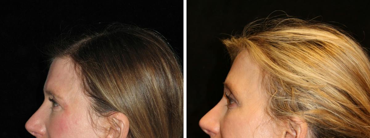 Brow Lift Before & After Gallery - Patient 331215 - Image 3