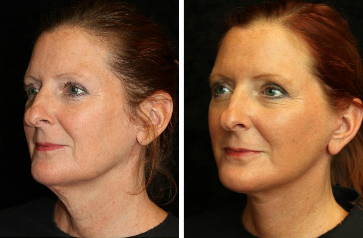 Facelift Before & After Gallery - Patient 145068 - Image 2