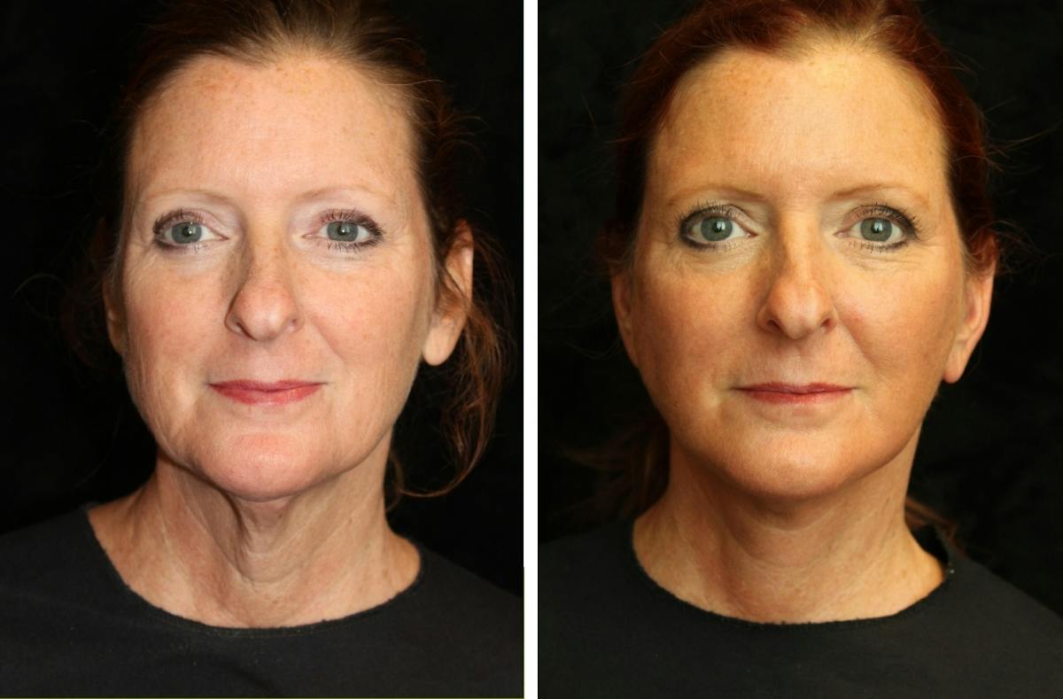 Facelift Before & After Gallery - Patient 145068 - Image 1
