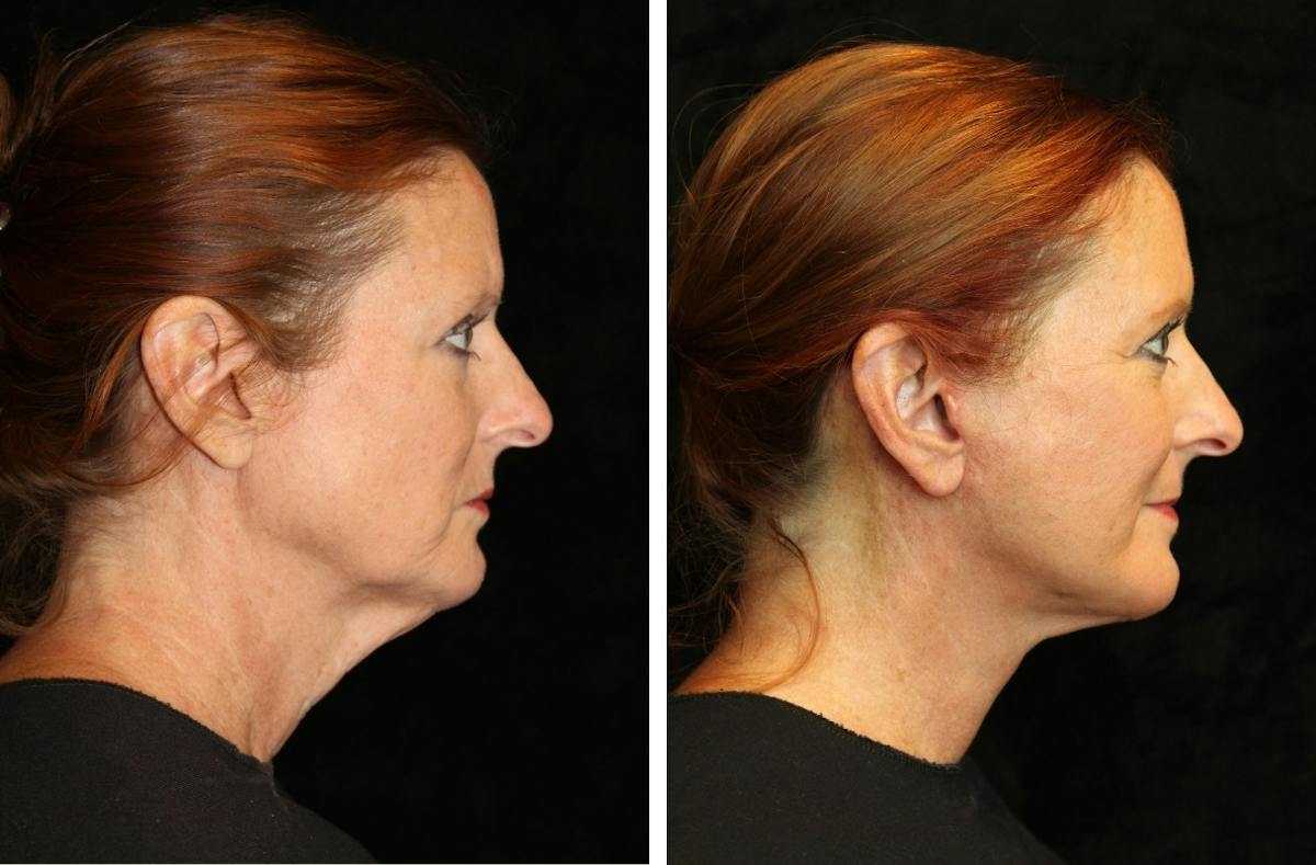 Facelift Before & After Gallery - Patient 145068 - Image 3