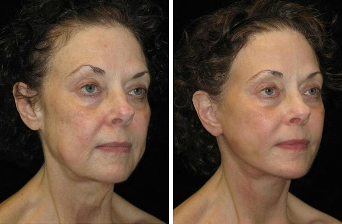 Facelift Before & After Gallery - Patient 136709 - Image 2