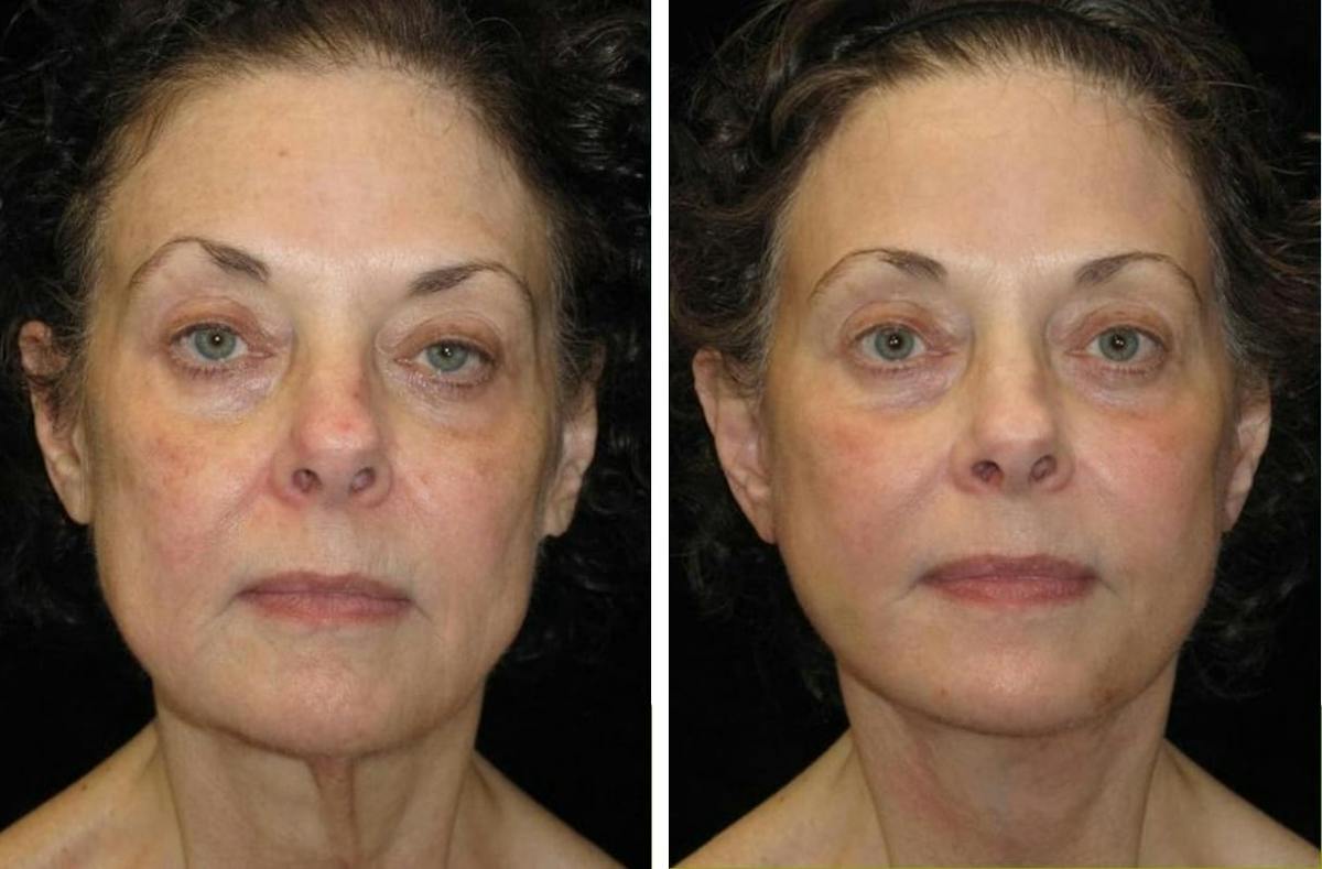 Facelift Before & After Gallery - Patient 136709 - Image 1