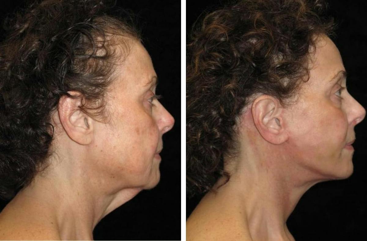 Facelift Before & After Gallery - Patient 136709 - Image 3