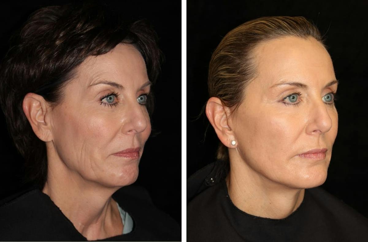 Facelift Before & After Gallery - Patient 137594 - Image 2