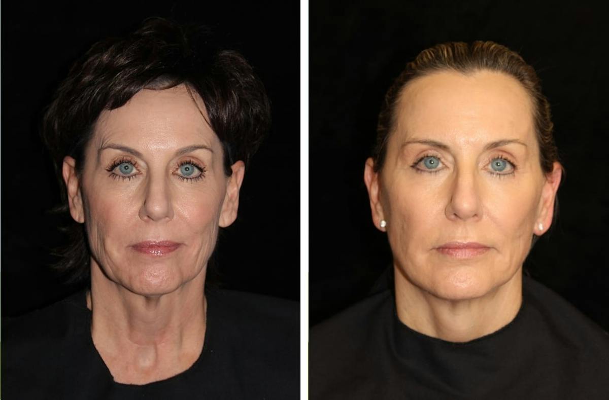 Facelift Before & After Gallery - Patient 137594 - Image 1