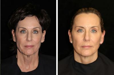 Facelift Before & After Gallery - Patient 137594 - Image 1