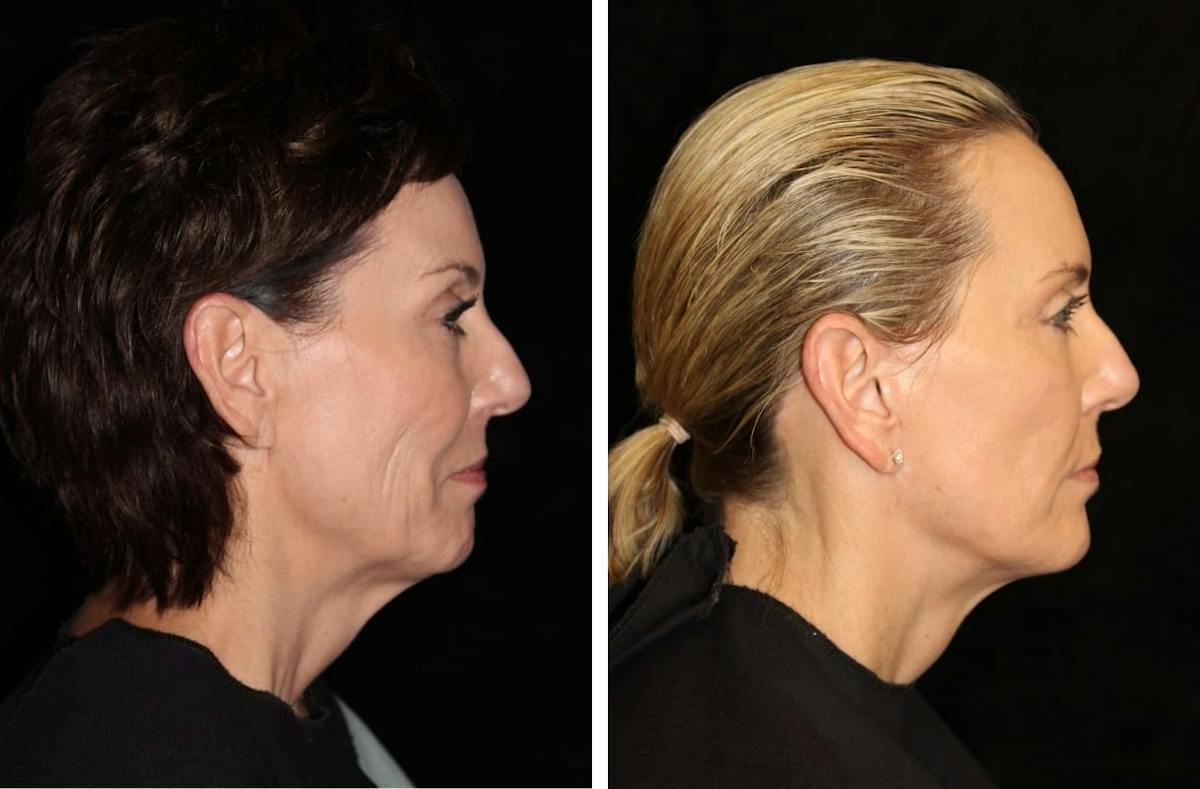 Facelift Before & After Gallery - Patient 137594 - Image 3