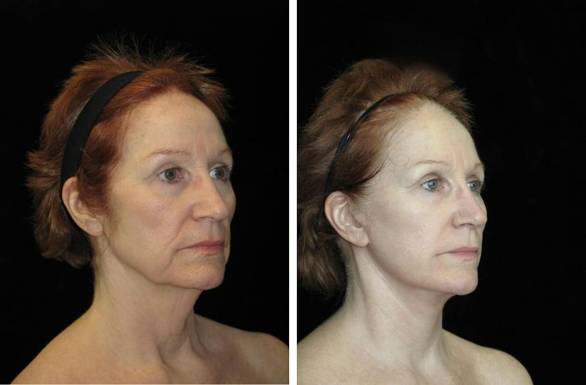 Facelift Before & After Gallery - Patient 122995 - Image 2