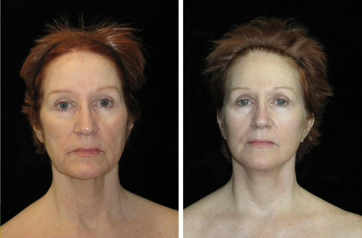 Facelift Before & After Gallery - Patient 122995 - Image 1