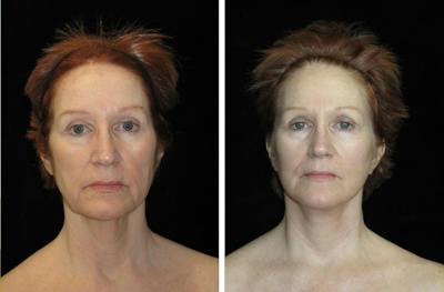 Facelift Before & After Gallery - Patient 122995 - Image 1