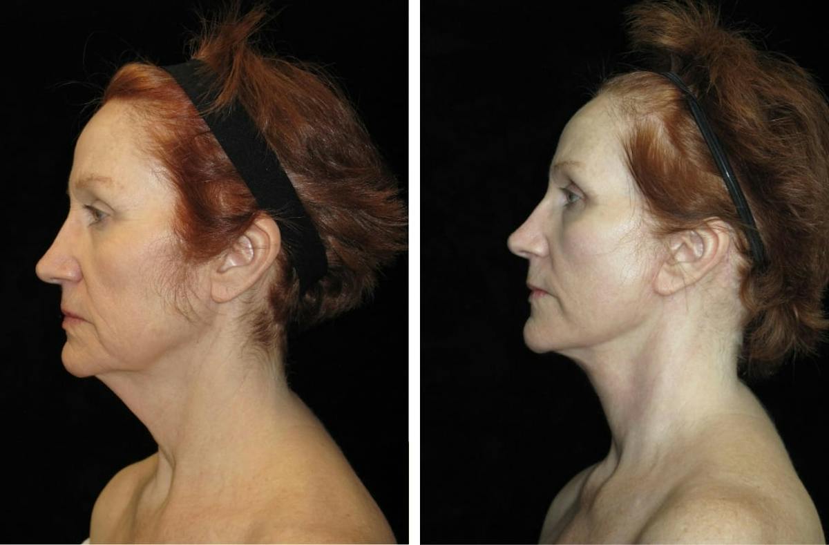 Facelift Before & After Gallery - Patient 122995 - Image 3