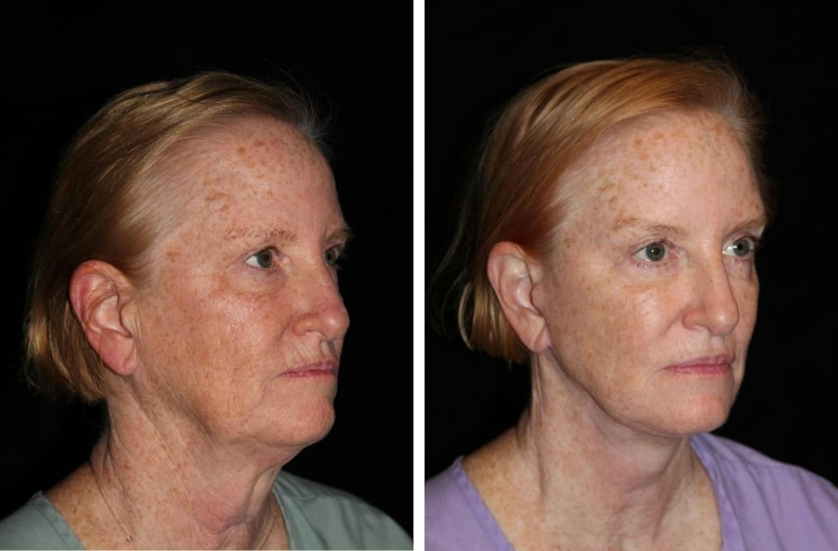 Facelift Before & After Gallery - Patient 388452 - Image 2