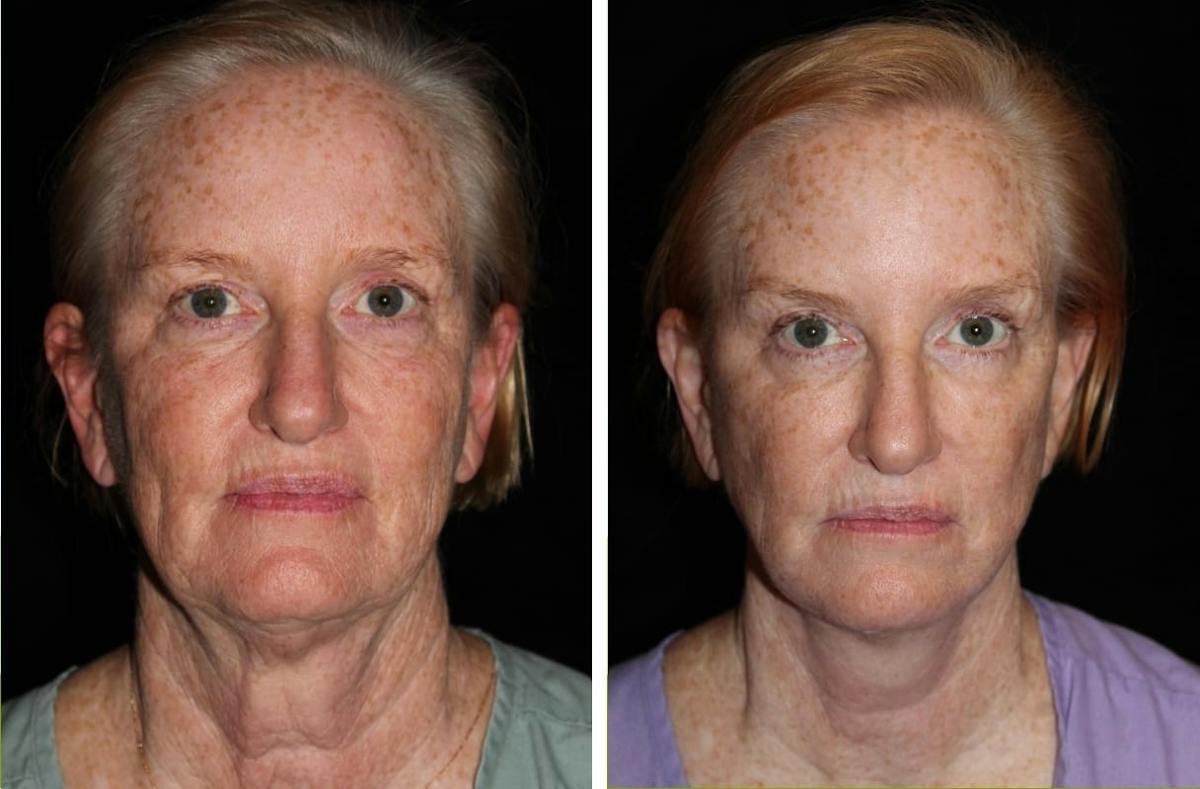 Facelift Before & After Gallery - Patient 388452 - Image 1