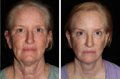 Facelift Before & After Gallery - Patient 388452 - Image 1