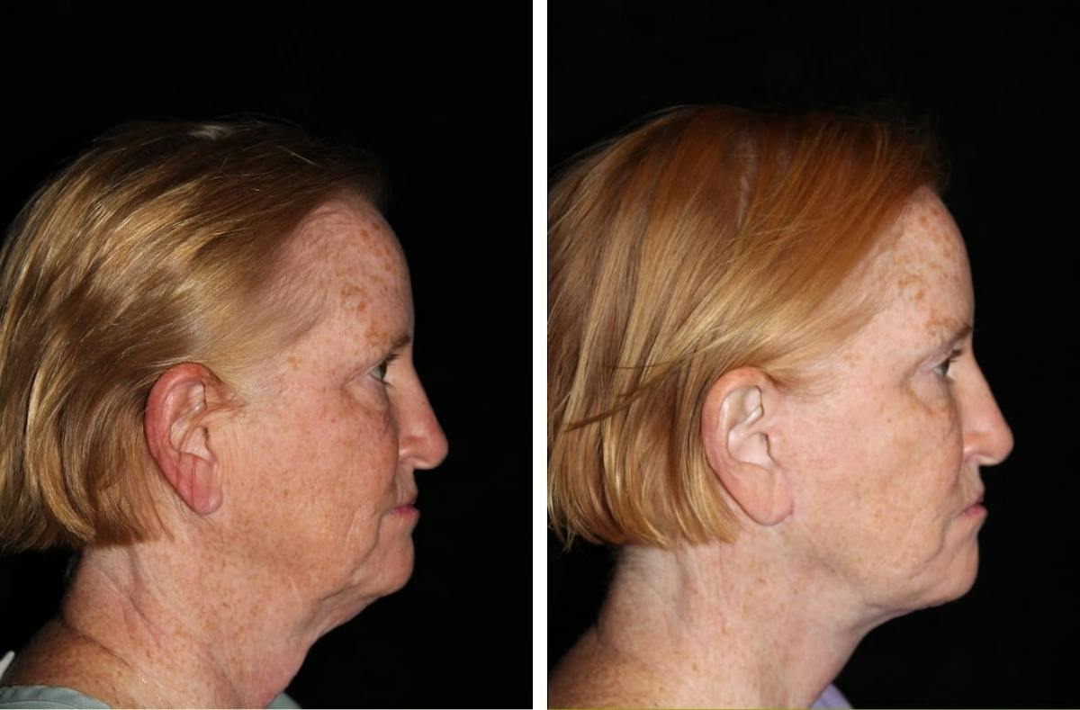 Facelift Before & After Gallery - Patient 388452 - Image 3