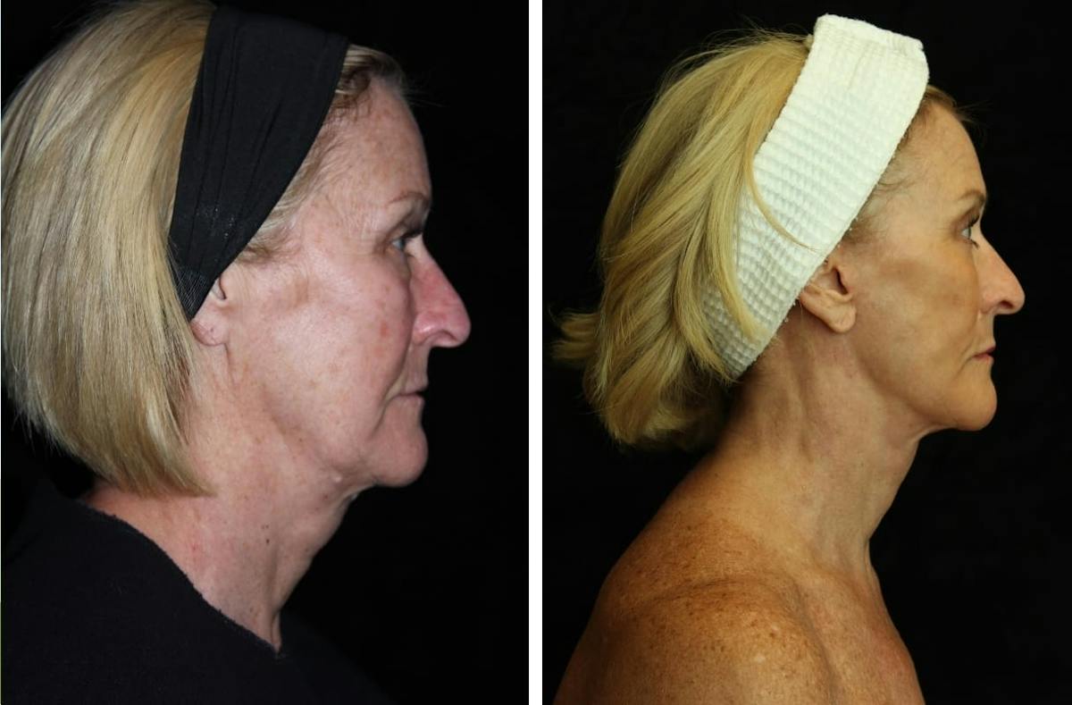 Facelift Before & After Gallery - Patient 275388 - Image 3
