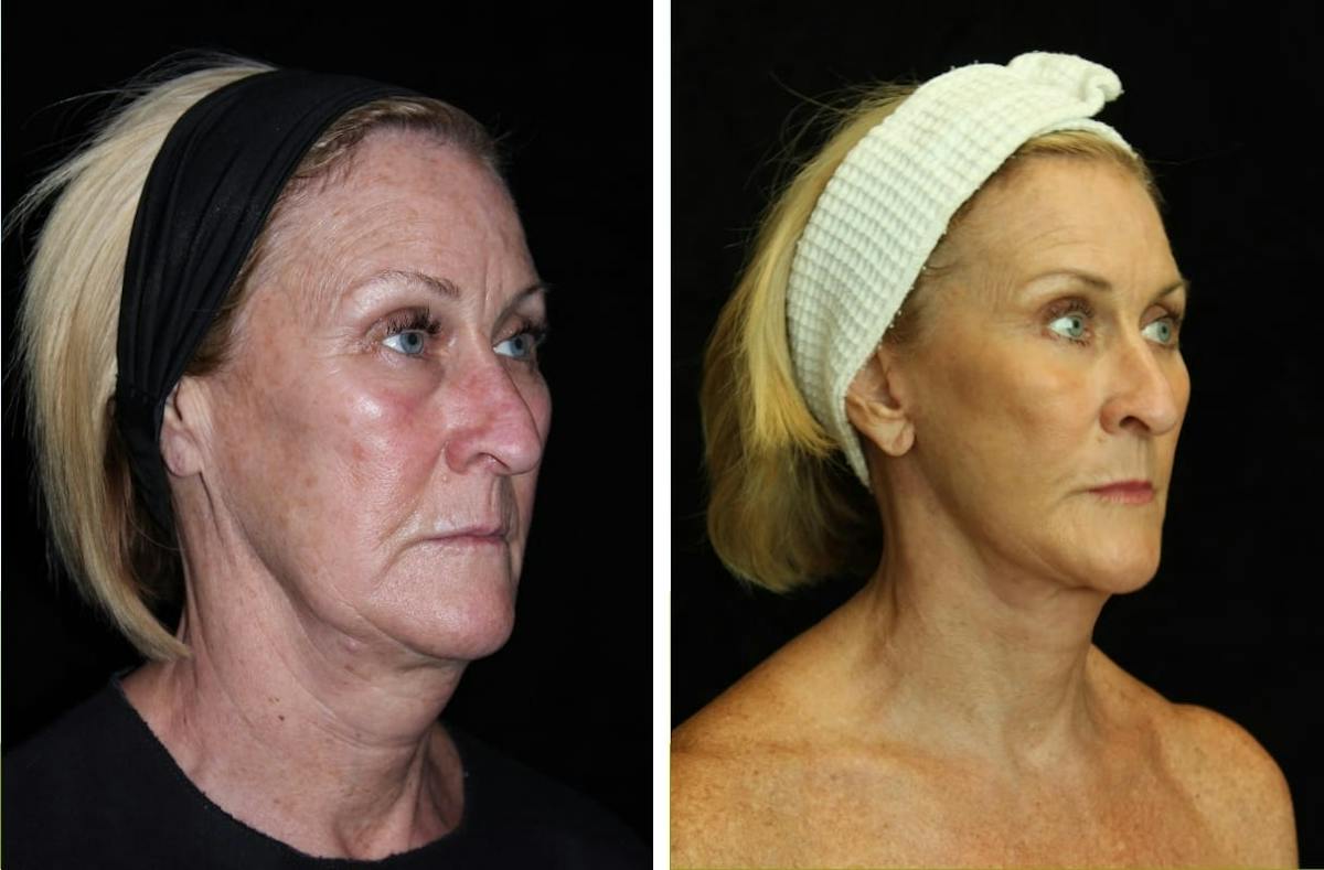 Facelift Before & After Gallery - Patient 275388 - Image 2