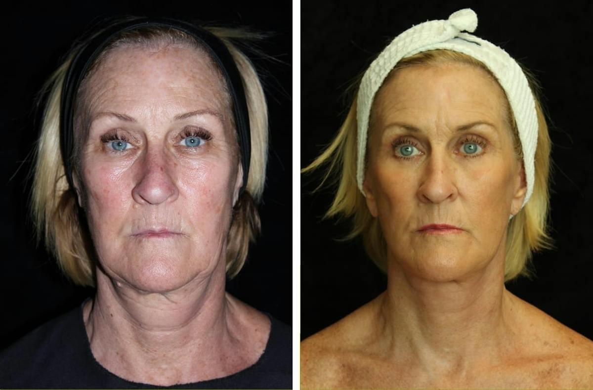 Facelift Before & After Gallery - Patient 275388 - Image 1