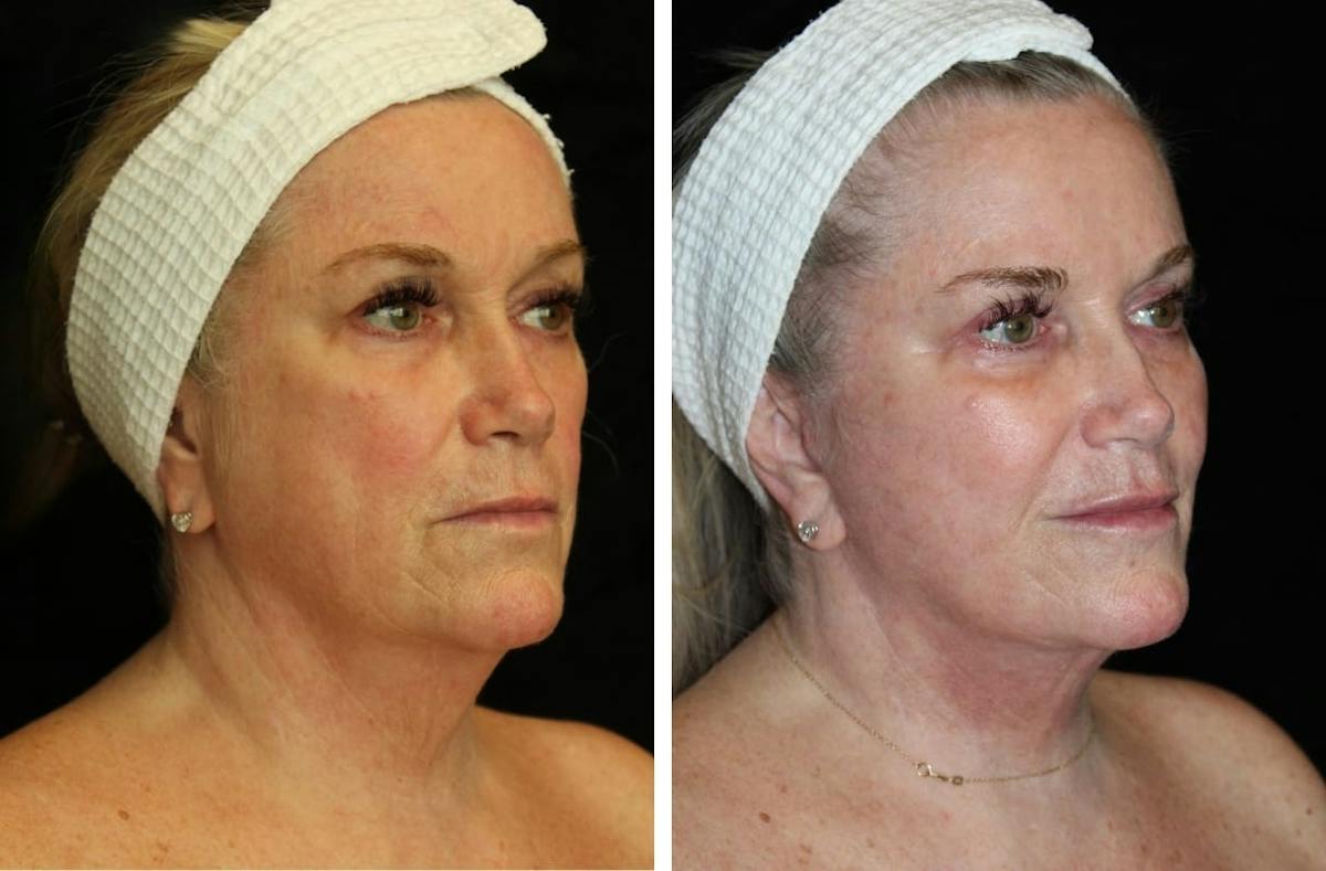 Facelift Before & After Gallery - Patient 410500 - Image 2