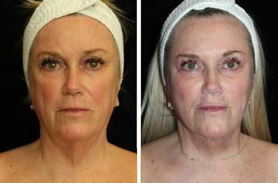Facelift Before & After Gallery - Patient 410500 - Image 1