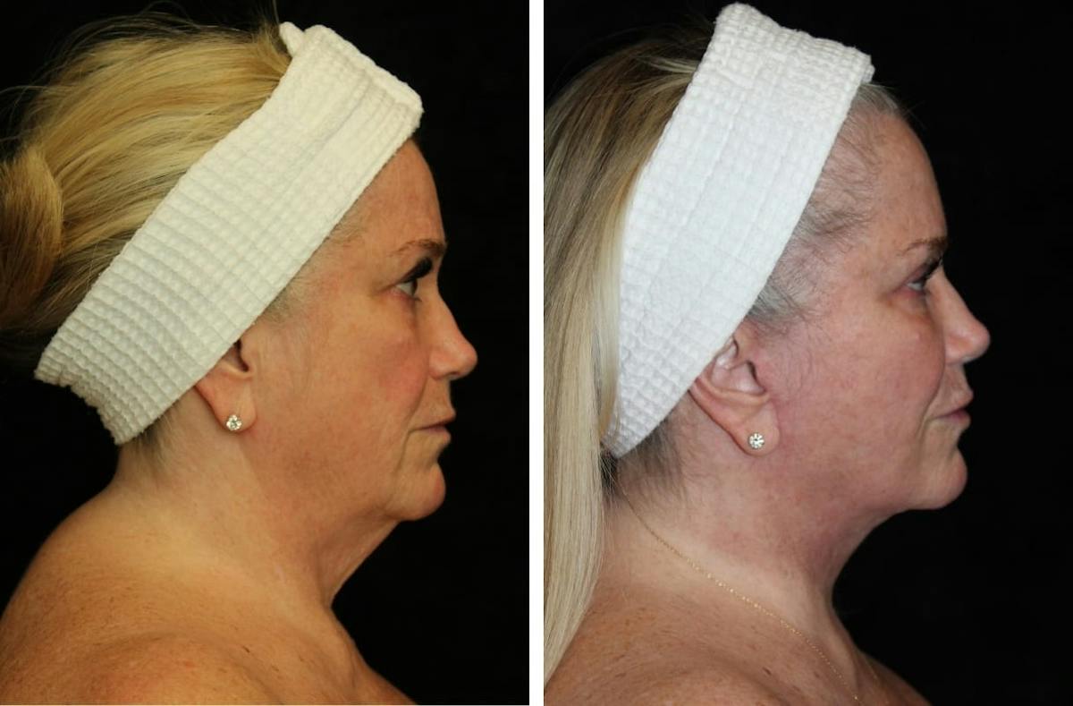 Facelift Before & After Gallery - Patient 410500 - Image 3