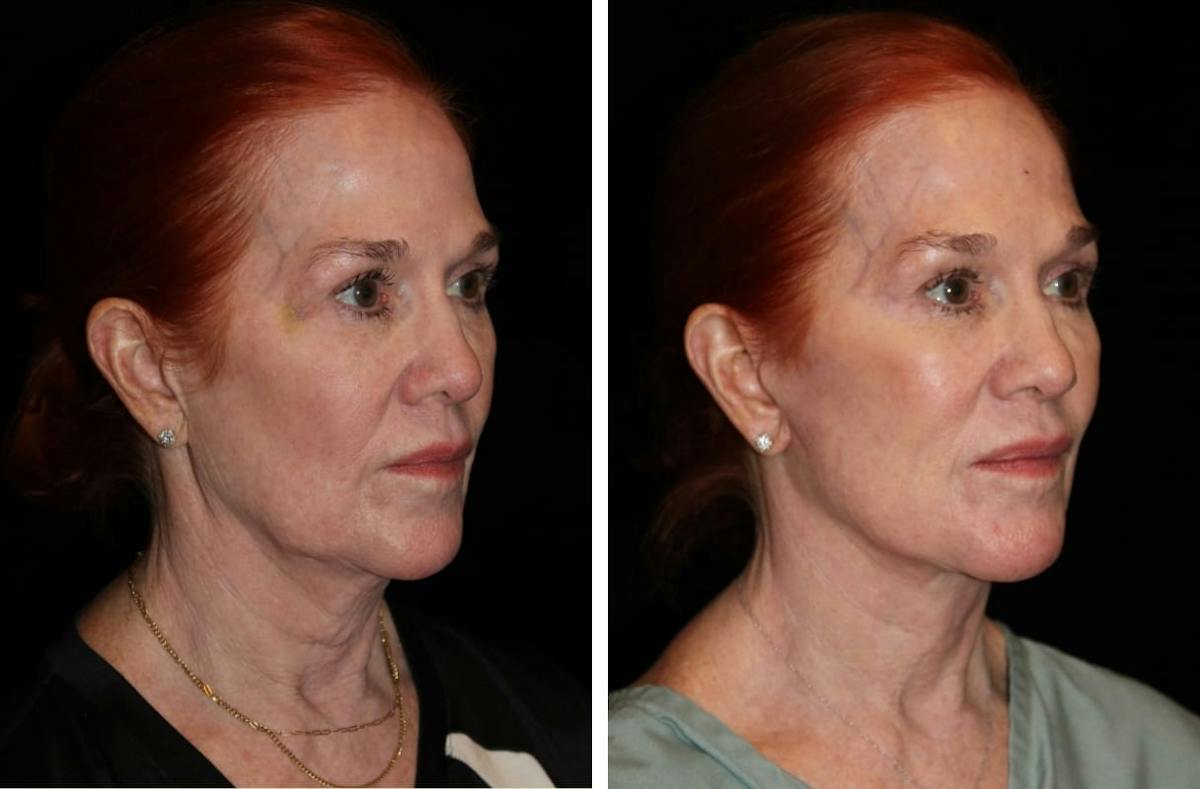 Facelift Before & After Gallery - Patient 144954 - Image 2