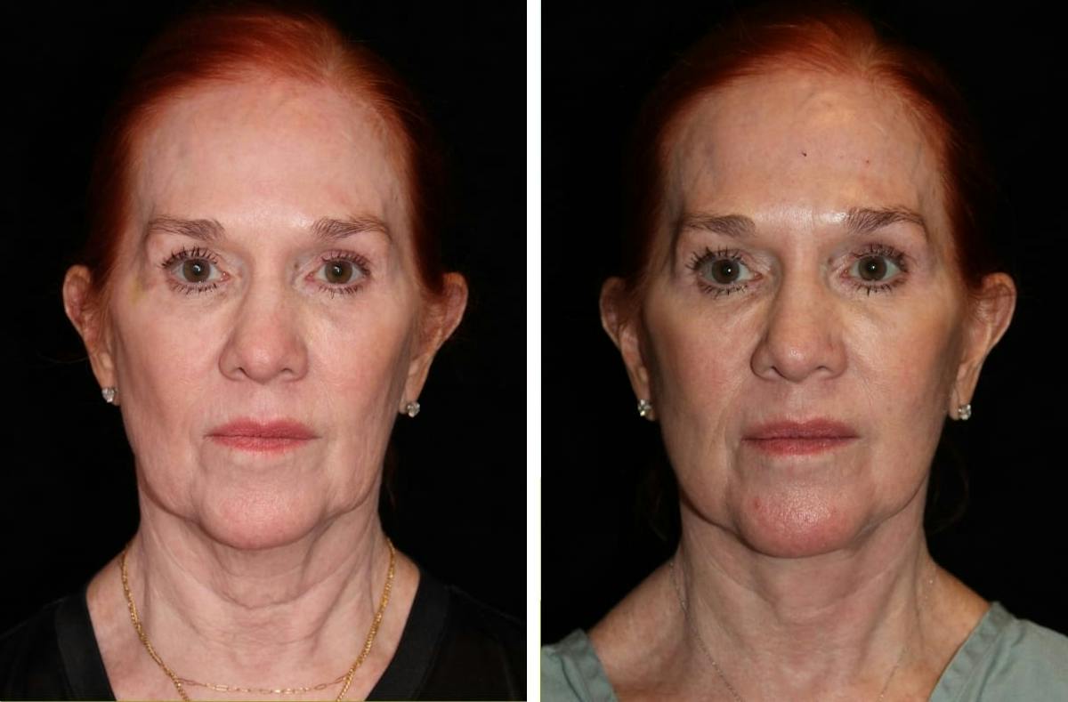 Facelift Before & After Gallery - Patient 144954 - Image 1