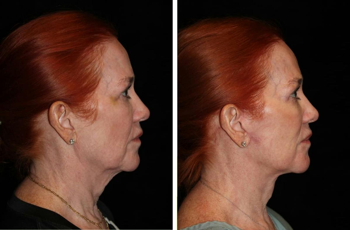 Facelift Before & After Gallery - Patient 144954 - Image 3