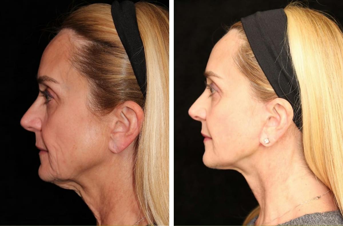 Facelift Before & After Gallery - Patient 665092 - Image 3