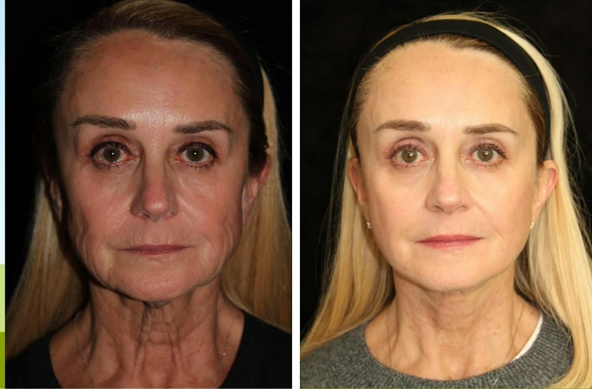 Facelift Before & After Gallery - Patient 665092 - Image 1