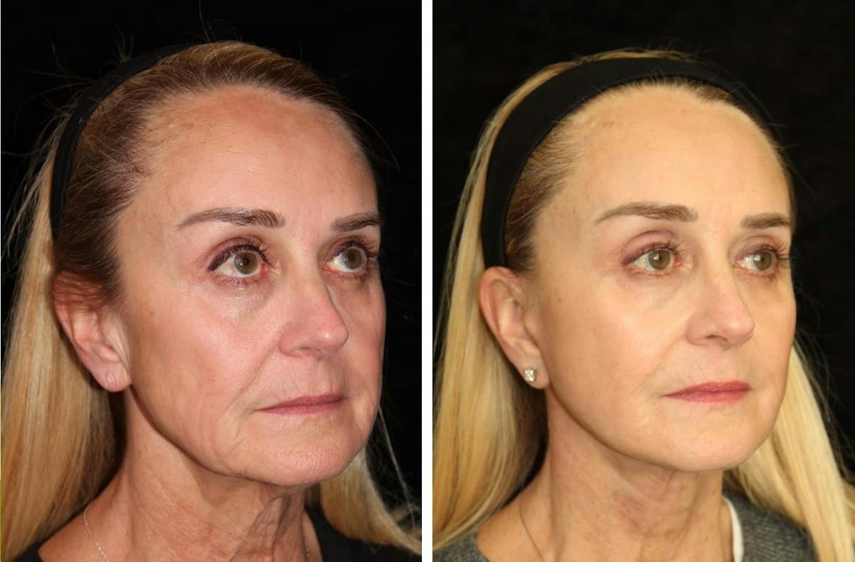 Facelift Before & After Gallery - Patient 665092 - Image 2
