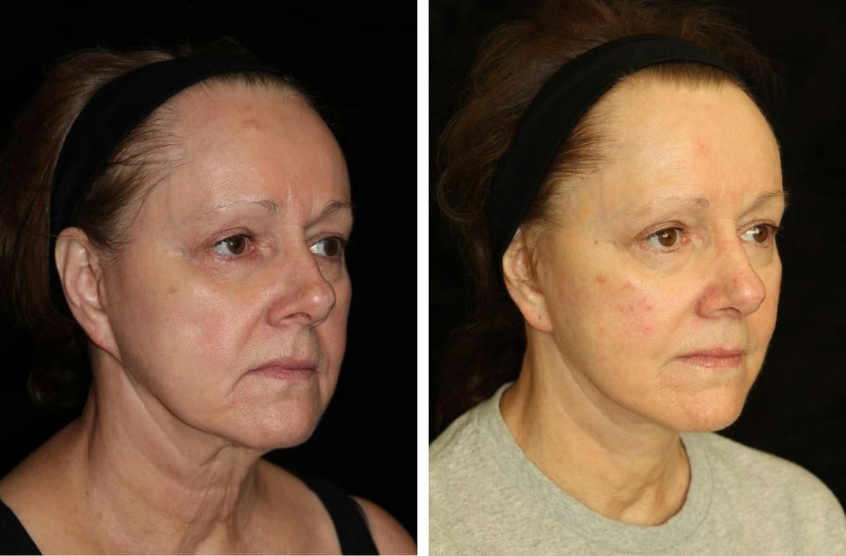 Facelift Before & After Gallery - Patient 290746 - Image 2