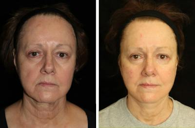 Facelift Before & After Gallery - Patient 290746 - Image 1