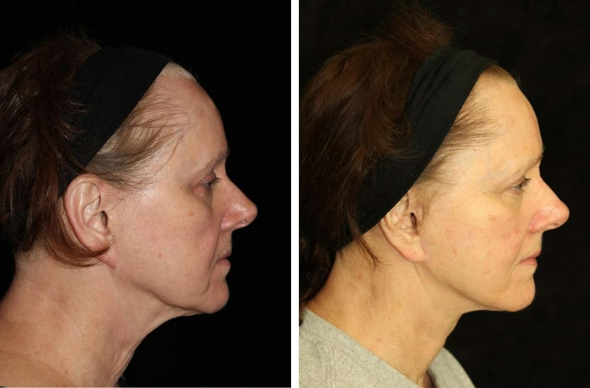 Facelift Before & After Gallery - Patient 290746 - Image 3