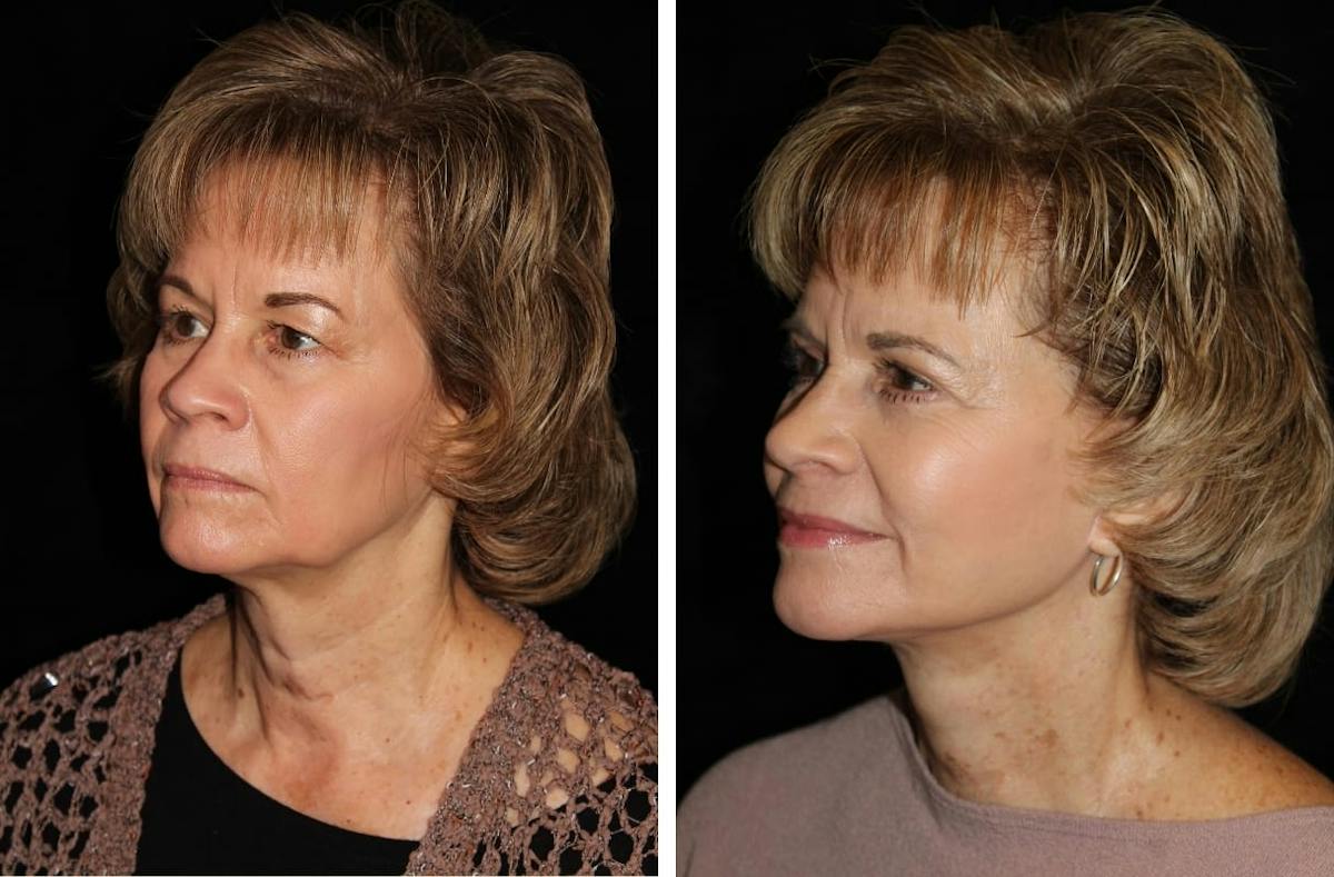 Facelift Before & After Gallery - Patient 299055 - Image 2