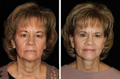Facelift Before & After Gallery - Patient 299055 - Image 1