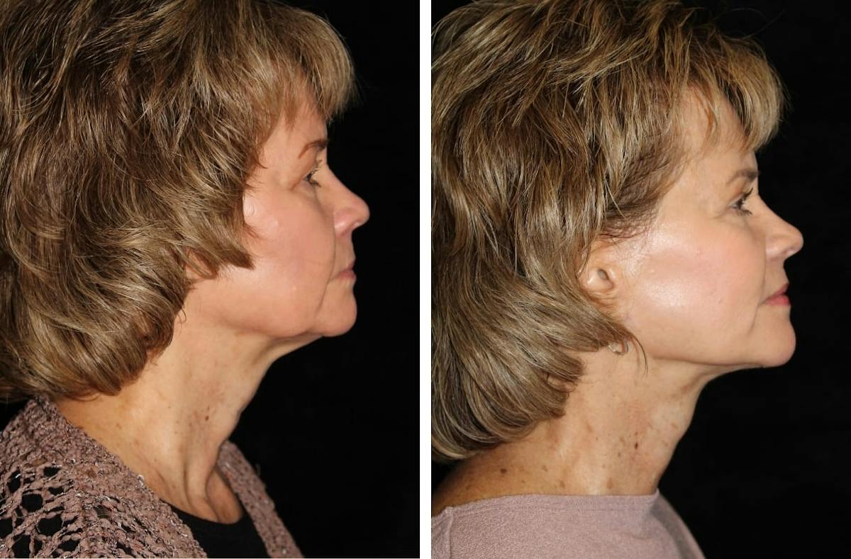 Facelift Before & After Gallery - Patient 299055 - Image 3