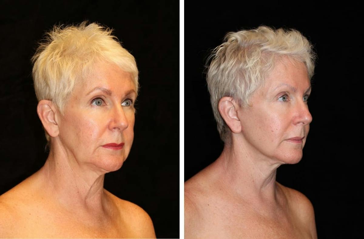 Facelift Before & After Gallery - Patient 171615 - Image 2