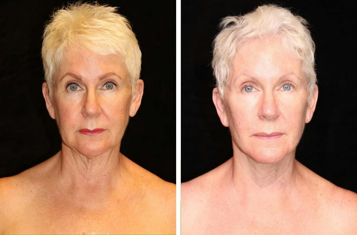 Facelift Before & After Gallery - Patient 171615 - Image 1