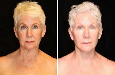 Facelift Before & After Gallery - Patient 171615 - Image 1