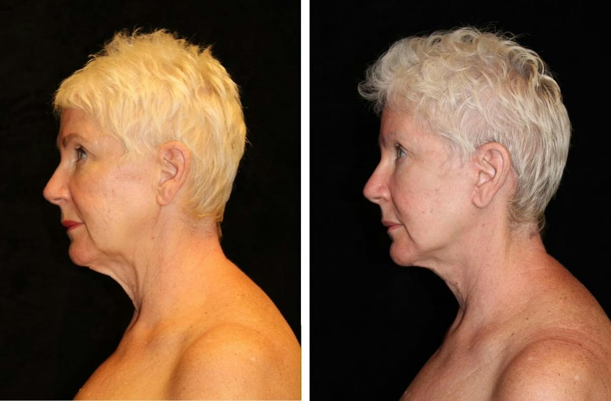 Facelift Before & After Gallery - Patient 171615 - Image 3