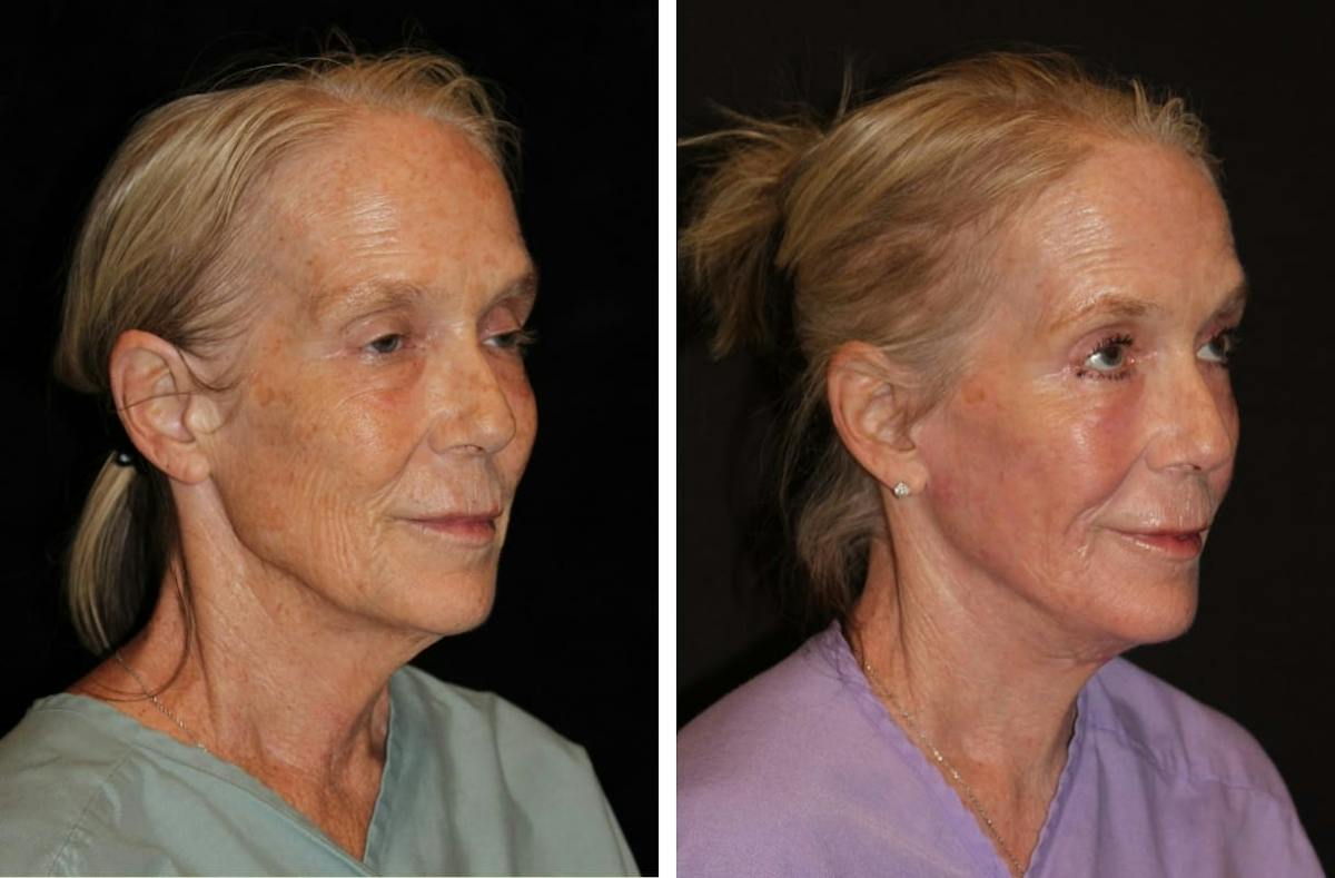 Facelift Before & After Gallery - Patient 221445 - Image 2